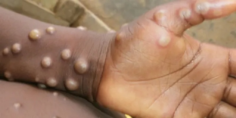 Monkeypox Case Confirmed Two Cases In Anambra